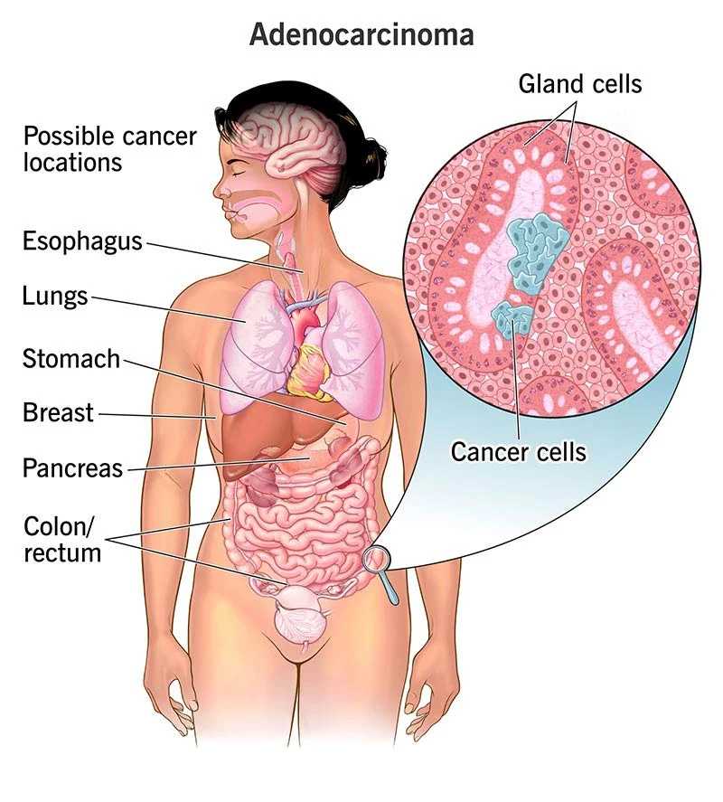 Adenocarcinoma Treatment Aastha Oncology Associates 6878